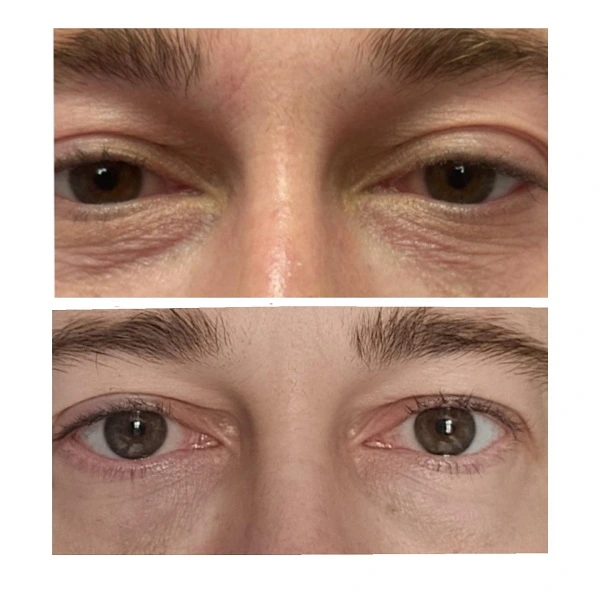 Lumi Eyes Before and After